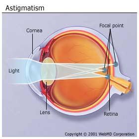 How to Fix Astigmatism