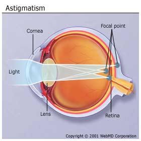 astigmatism fix correct