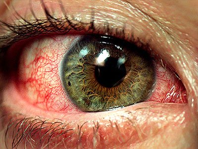 How to Cure Bloodshot Eyes