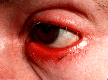 Americans Have Ocular Rosacea