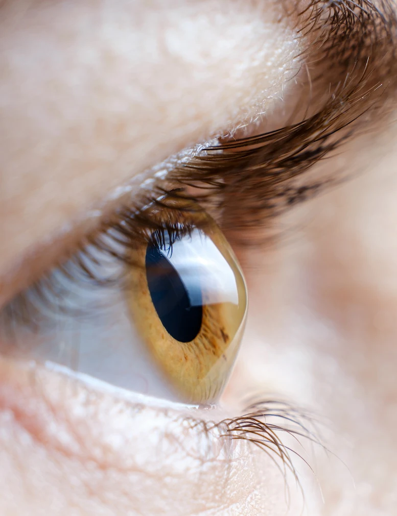 eye with keratoconus