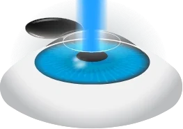 Laser reshapes cornea